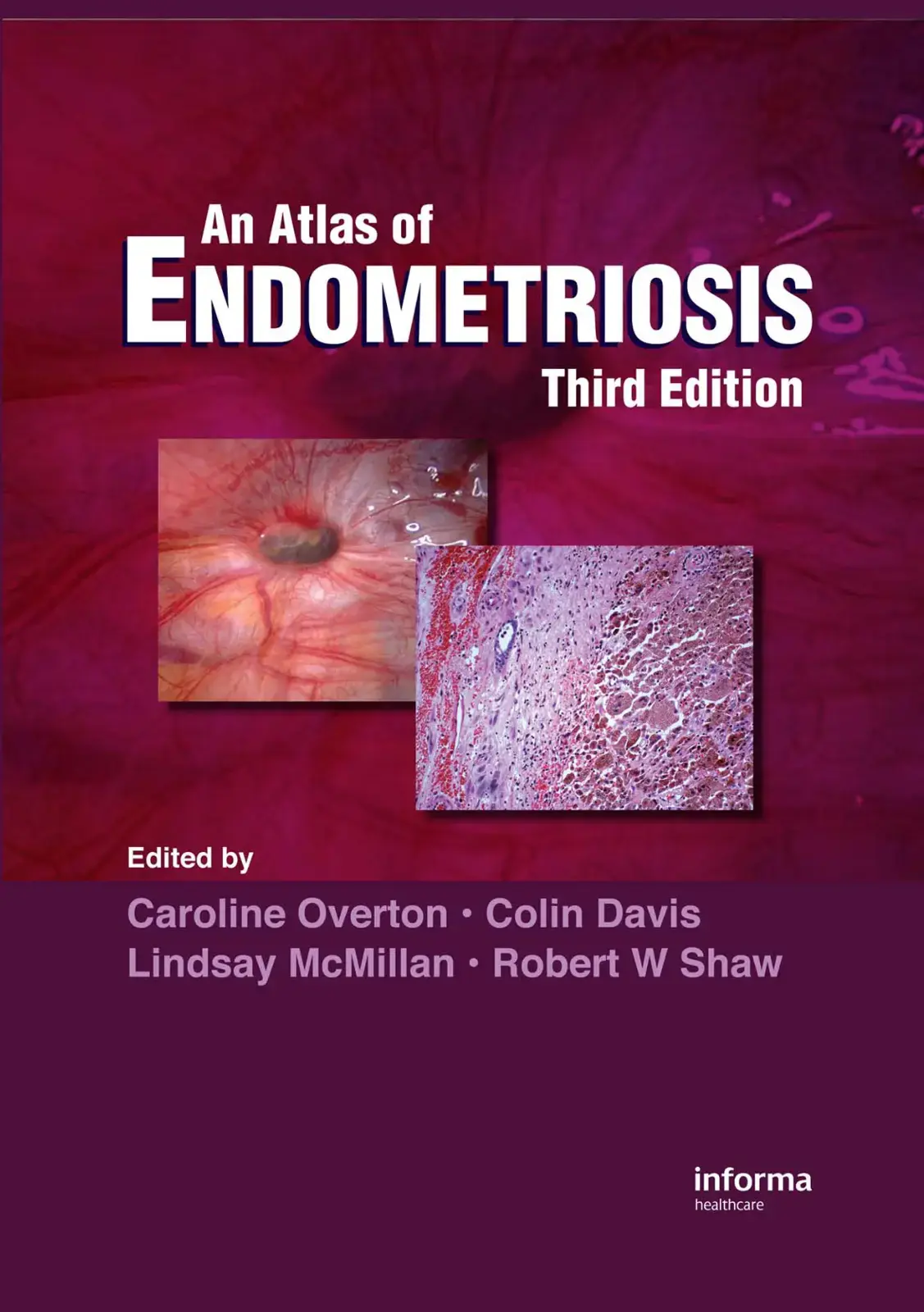 غلاف كتاب An Atlas of ENDOMETRIOSIS