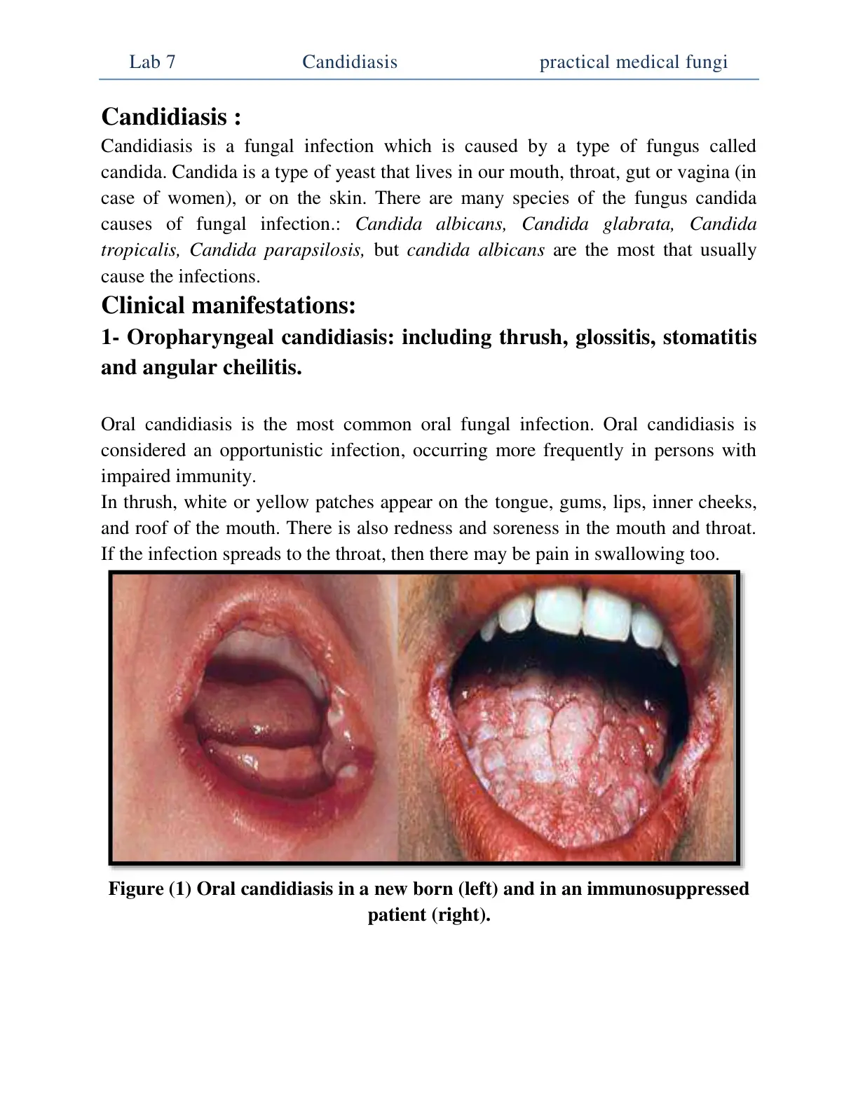 غلاف تقرير Candidiasis