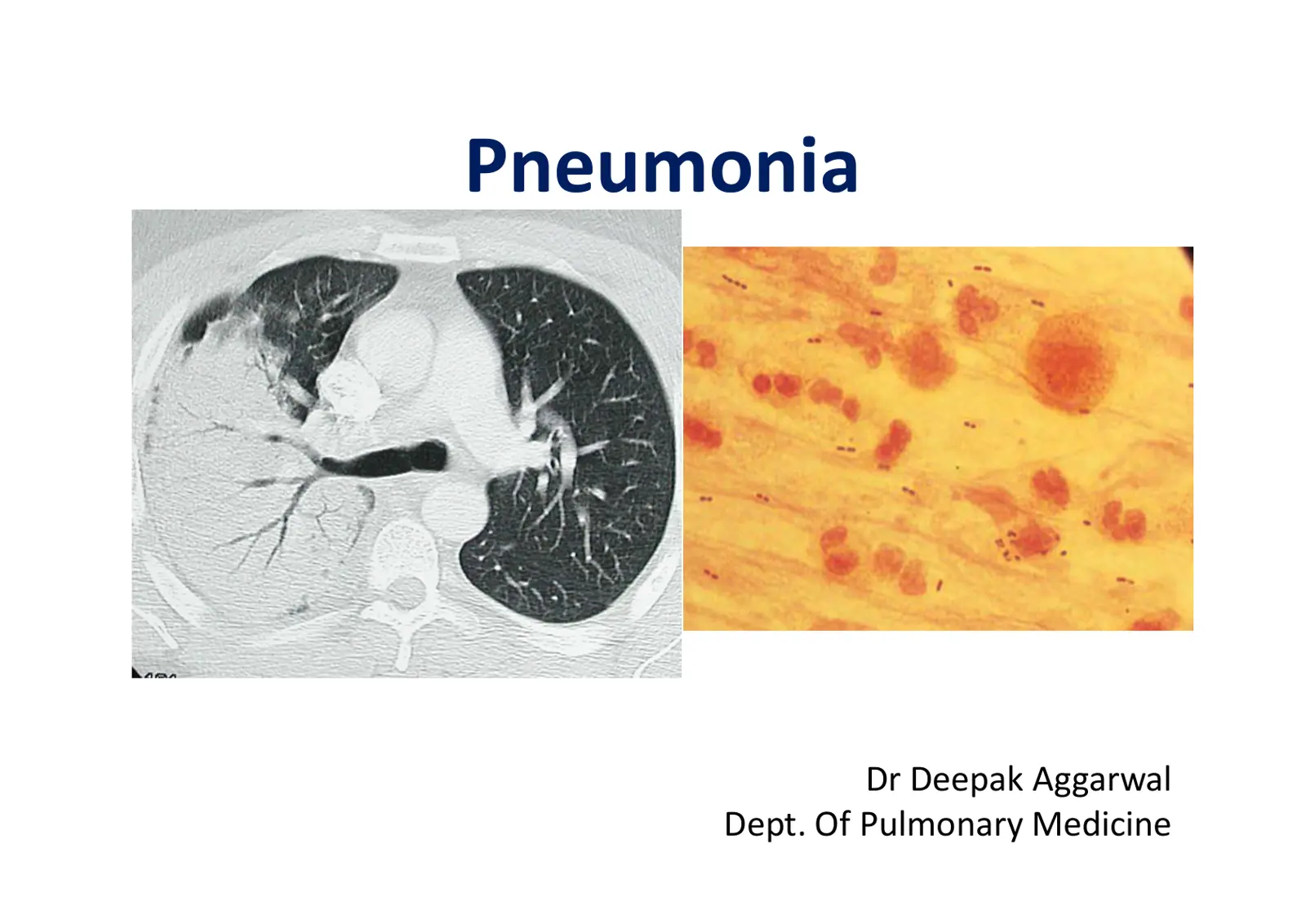 غلاف تقرير Pneumonia