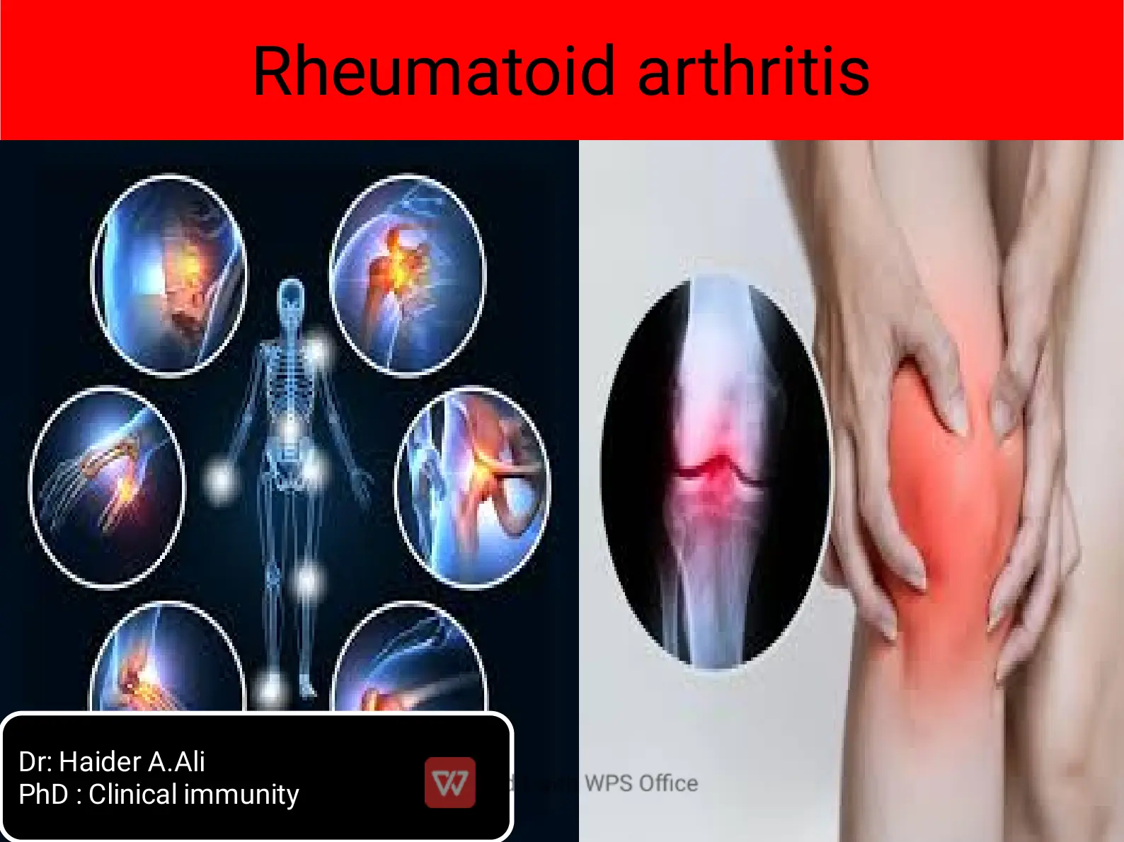 غلاف تقرير Rheumatoid arthritis