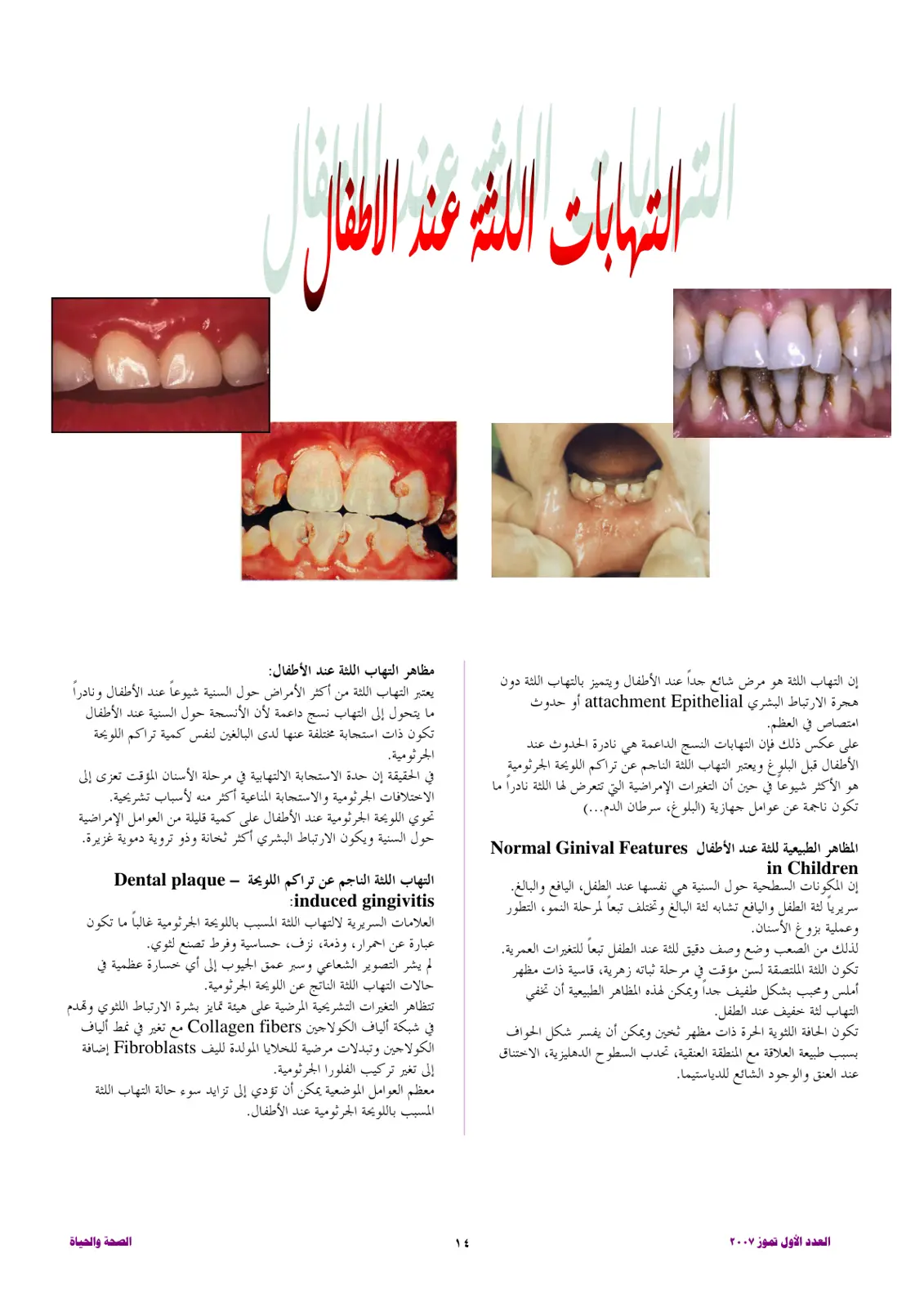 غلاف تقرير التهابات اللثة عند الأطفال