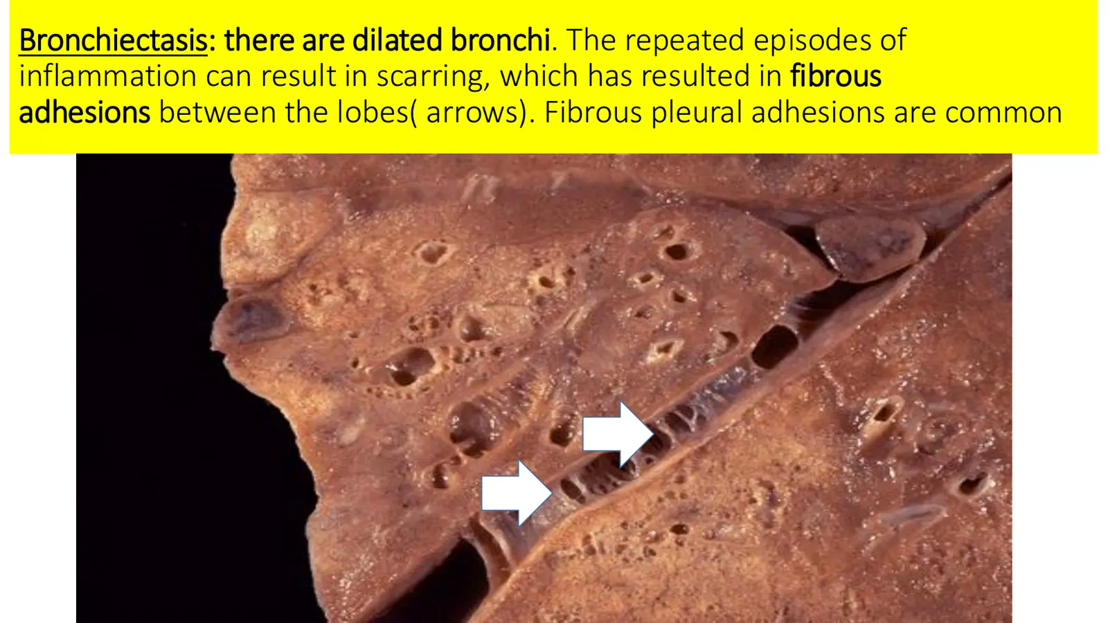 غلاف تقرير Bronchiectasis: there are dilated bronchi. The repeated episodes of inflammation can result in scarring, which has resulted in fibrous adhesions between the lobes( arrows). Fibrous pleural adhesions are common.