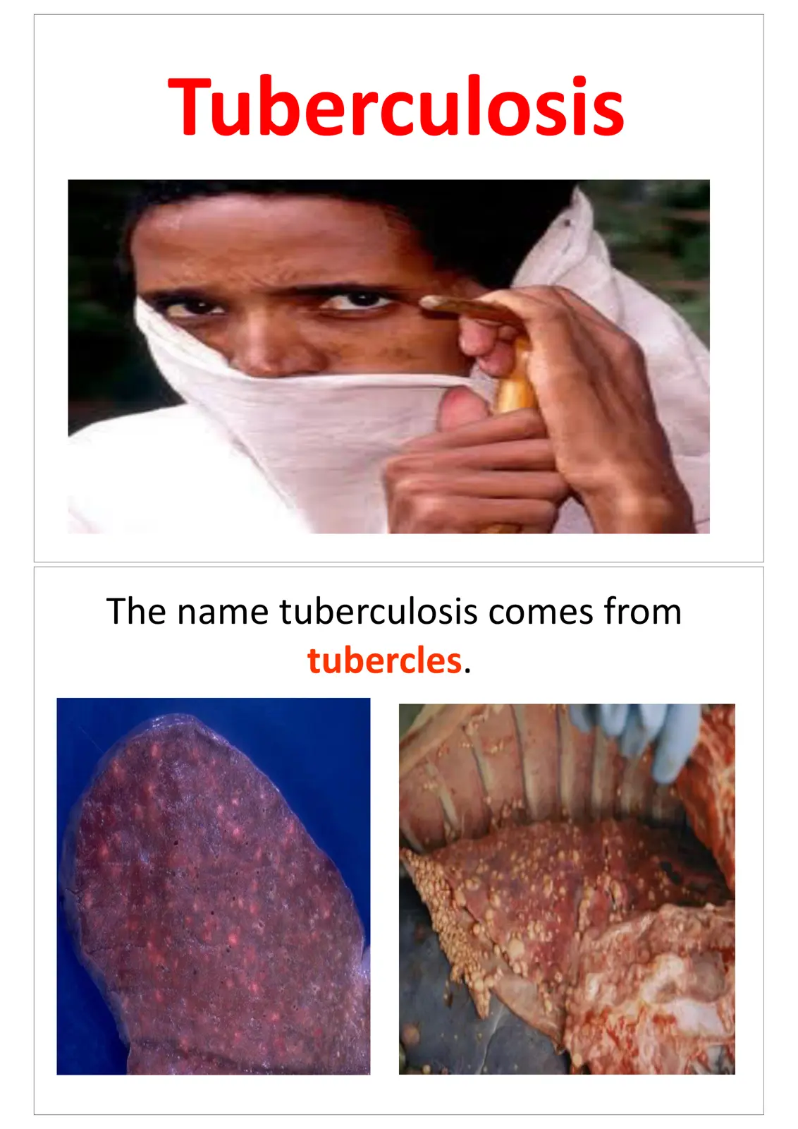 غلاف تقرير Tuberculosis