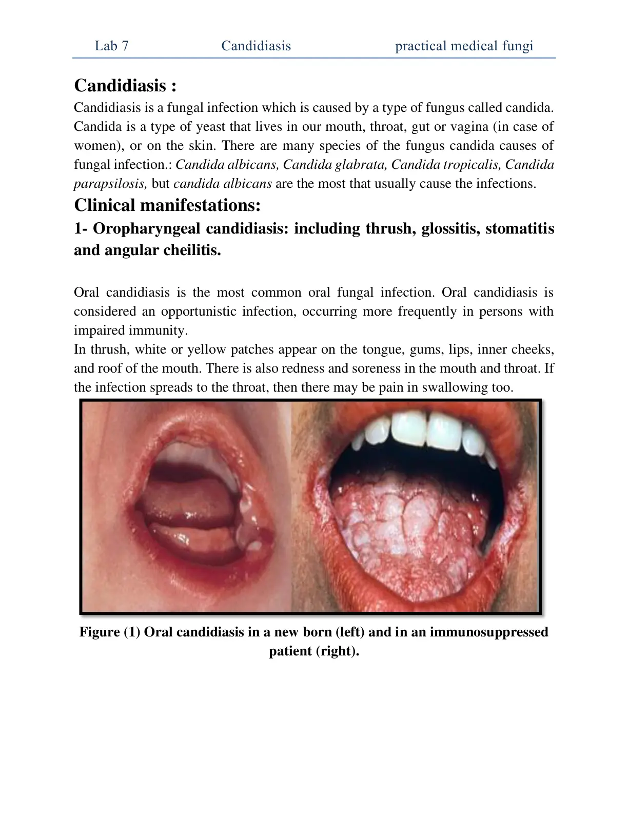 غلاف تقرير Candidiasis